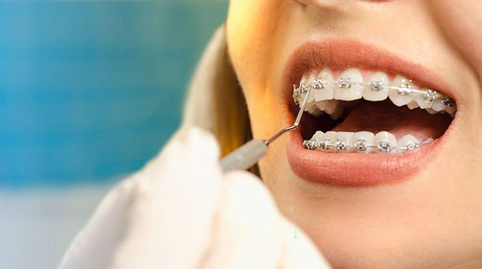 Orthodontic-Devices